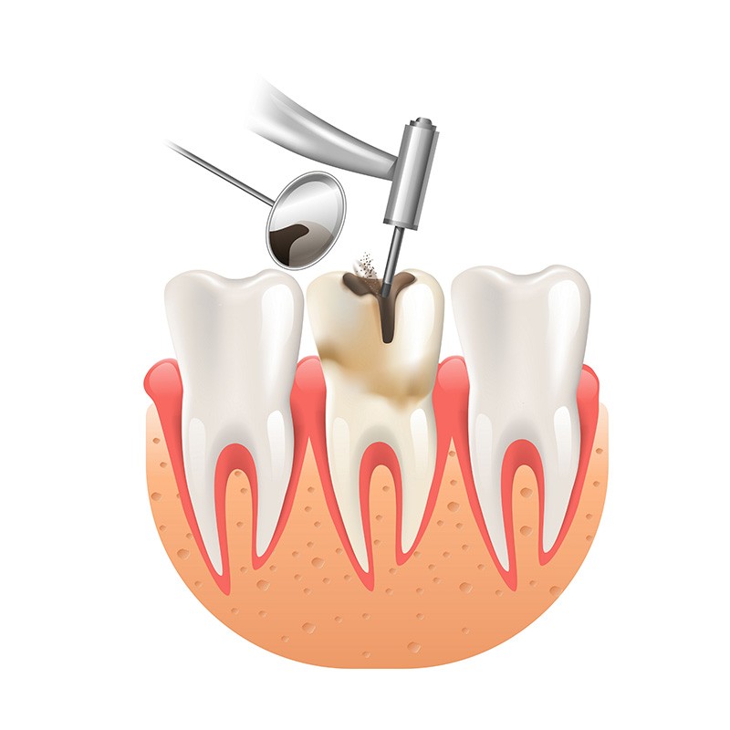 Tooth filling