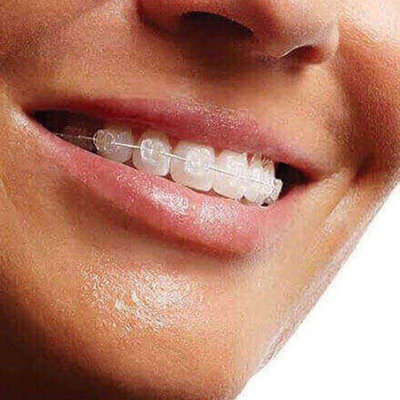 Ceramic braces