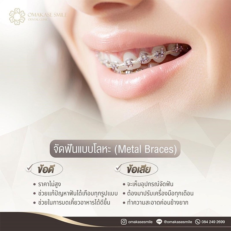 Metal braces