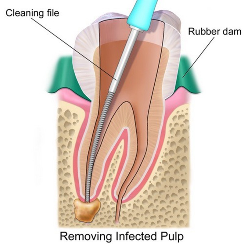 Root canal treatment